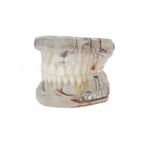 Modelo Dental Transparente de Implante con Nervio