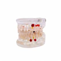 Modelo Dental Transparente Caries 32 Dientes